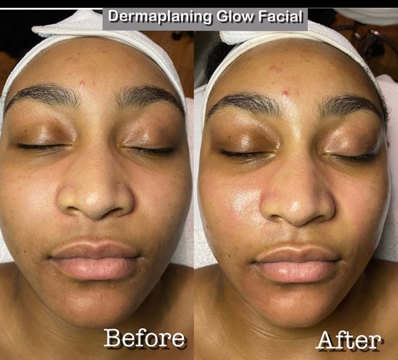 Dermaplaning Glow Facial (Full Price 140) Tati's Skincare